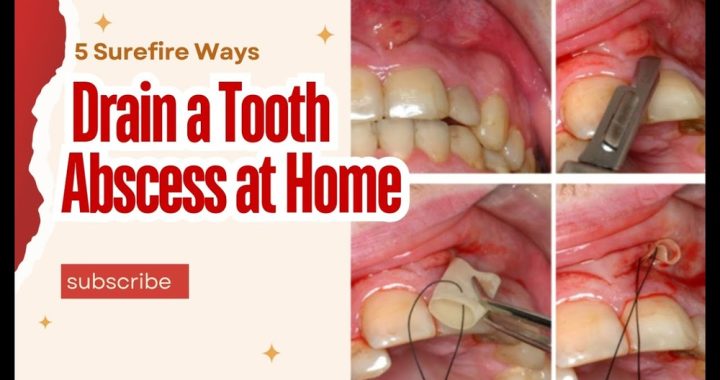 How to Drain Tooth Abscess at Home