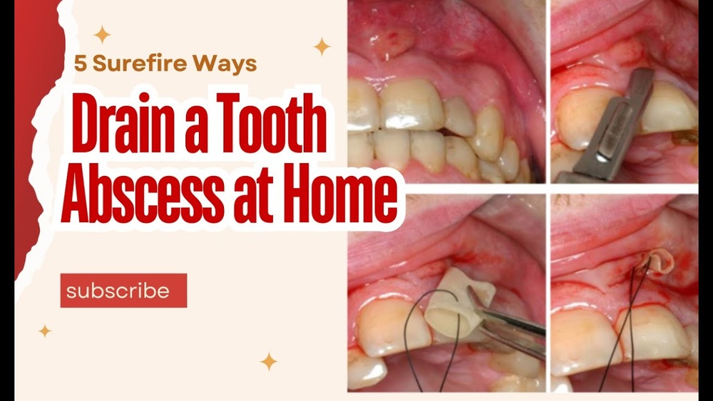 How to Drain Tooth Abscess at Home